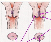 120819_cervical_erosion_3.jpg